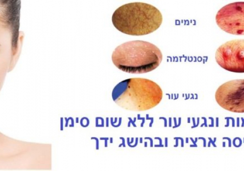 הסרת נקודות חן ונגעי עור בלייזר 5 דברים שחייבים לדעת על הטיפול