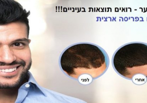 טיפול PRP לשיער הפתרון הטבעי לשיער דליל