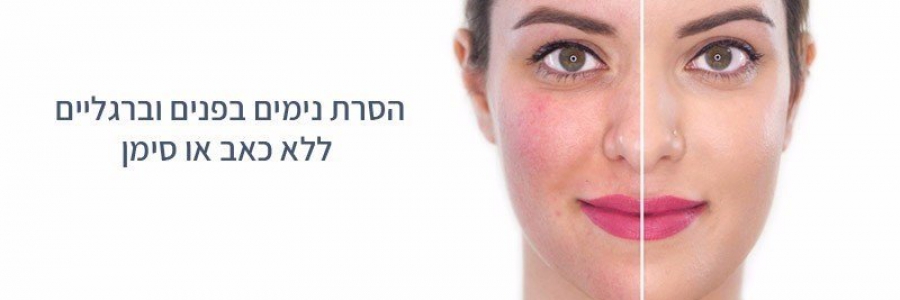 העלמת נימים בלייזר ללא כאב או סימן העלמת נימים בלייזר ללא כאב או סימן
