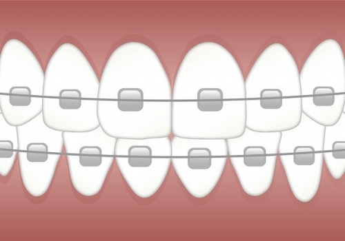 הטכנולוגיה בשירות האורתודונטיה: 5 שיטות מתקדמות ליישור שיניים