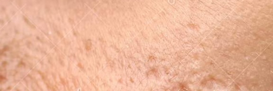 אקנה: מה זה וממה זה נובע אקנה: מה זה וממה זה נובע