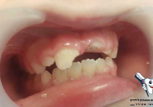 השלמת שן שבורה לילדים